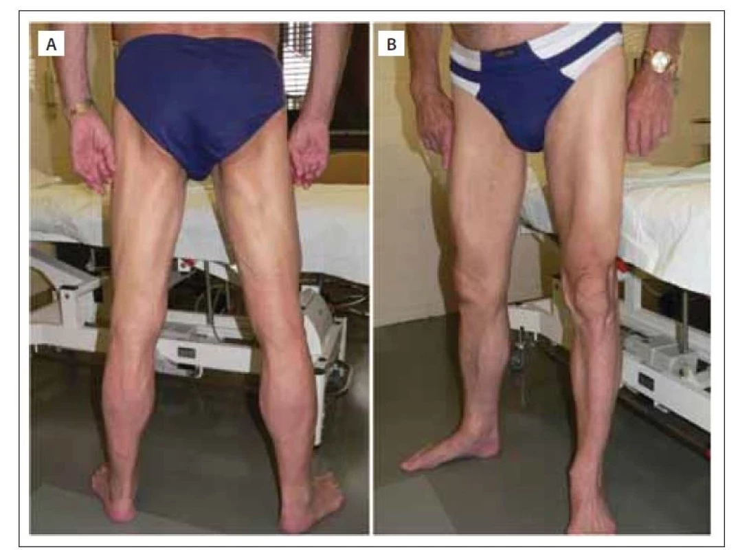 Pacient s LGMD R12 anoctamin 5-related.<br>
(A) Atrofie hamstringů, zejména dlouhé hlavy m. biceps femoris při relativně ušetřené krátké
hlavě. (B) Typická selektivní atrofie m. vastus medialis a lateralis, na lýtkách nápadná atrofie
m. gastrocnemius medialis oboustranně symetricky.<br>
LGMD – pletencové svalové dystrofie<br>
Fig. 5. Patient with LGMD R12 anoctamin 5-related.<br>
(A) Hamstring atrophy, especially of the long head of the biceps femoris with a relative
sparing of the short head. (B) Typical selective atrophy of the medial and lateral vastus
muscles, and on the calves, conspicuous atrophy of the medial gastrocnemius symmetrically
on both sides.<br>
LGMD – limb girdle muscular dystrophy