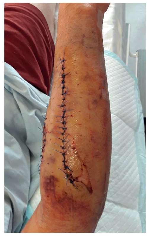 Pravé předloktí dorzáně, 8. pooperační den<br>
Fig. 6: Dorsal view of the right forearm, postoperative day 8