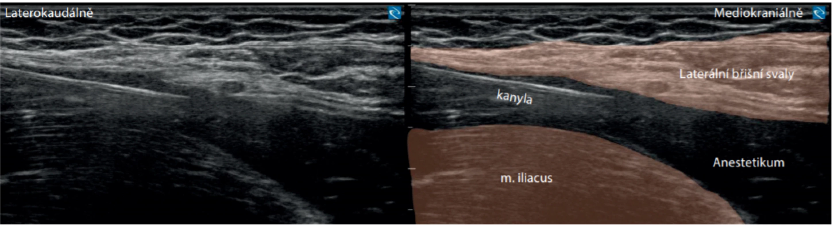 Suprainquinální fascia iliaca blok (FIB). Stav během aplikace 30 ml 0,35% marcainu. Je patrné oddálení fascia iliaca od fascií bočních svalů
břišních. Aplikační kanyla vytváří artefakt reverberace