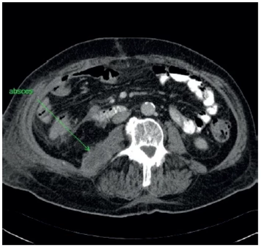 Vzťah abscesu k orgánom brušnej dutiny, nie je
jasné intra- alebo extraperitoneálne uloženie <br> 
Fig. 1. The relationship of the abscess to the abdominal
organs with difficulty to distinguish its intra- or extraperitoneal
location