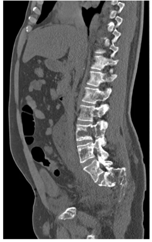 CT scan (sagitální rovina), kostní okno – osteolytické změny
skeletu LS páteře