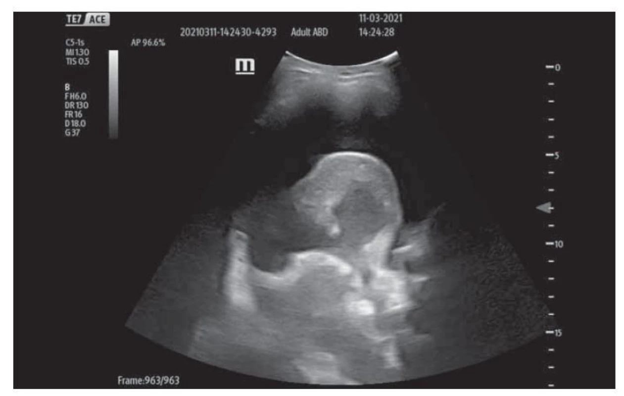 Pravá hrudní dutina se zkolabovanou plící.<br>
Fig. 1. Right hemithorax with collapsed lung.