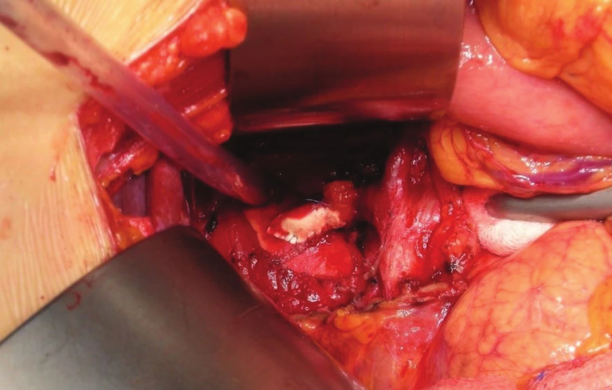 Path plastika truncus coeliacus<br>
Fig. 2: Celiac axis patch plastic