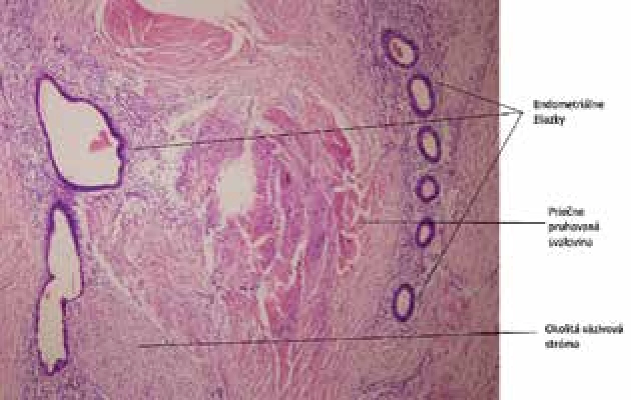 Endometrióza v jazve: prítomné je husté kolagénové väzivo, svalové vlákna a endometriálne žliazky. Farbenie Hematoxylín-eozín 40×<br>
Fig. 6: Abdominal wall endometriosis: collagen tissue, 
muscle fibres and endometrial glands, HE 40×