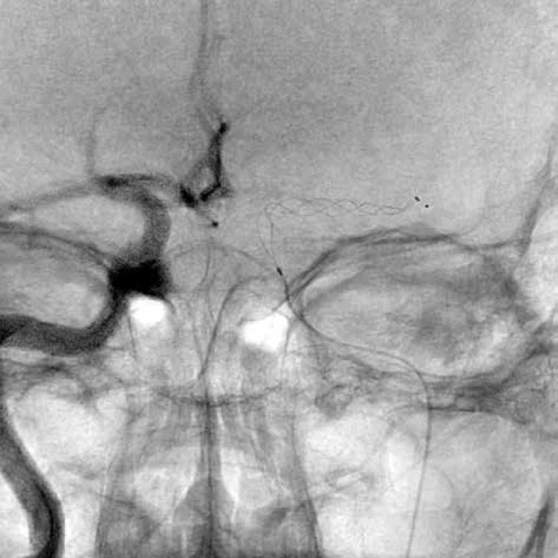 Stent retriever v M1 arteria cerebri media vlevo<br>
Fig. 1: Stent retriever in the M1 part of left middle cerebral
artery