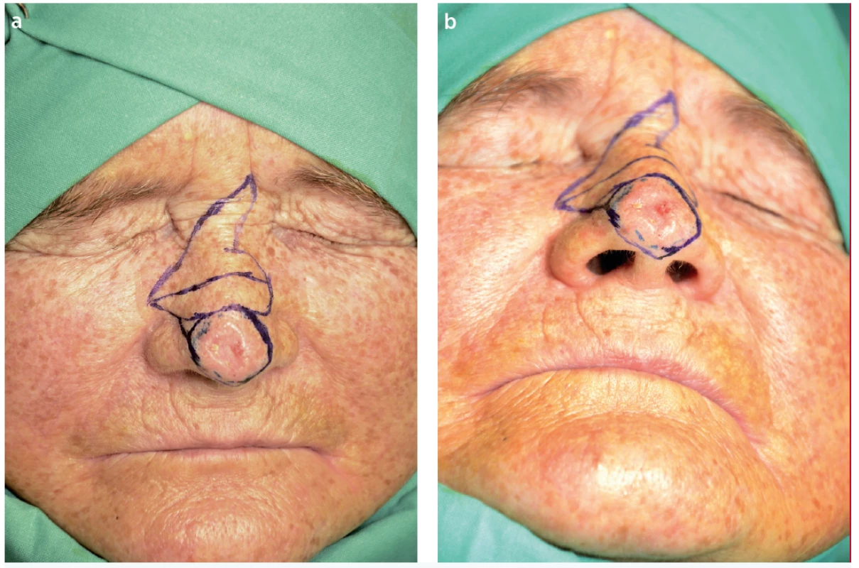 a,b. Preoperative marking (Author’s archive)