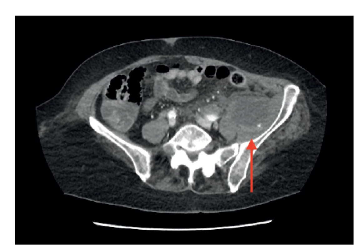 Pacientka 1, CT vyšetření ve venózní fázi, objemný
hematom levého retroperitonea zvýrazněn šipkou<br>
Fig. 1: Patient 1, venous phase CT, large hematoma in the
left retroperitoneum (arrow)