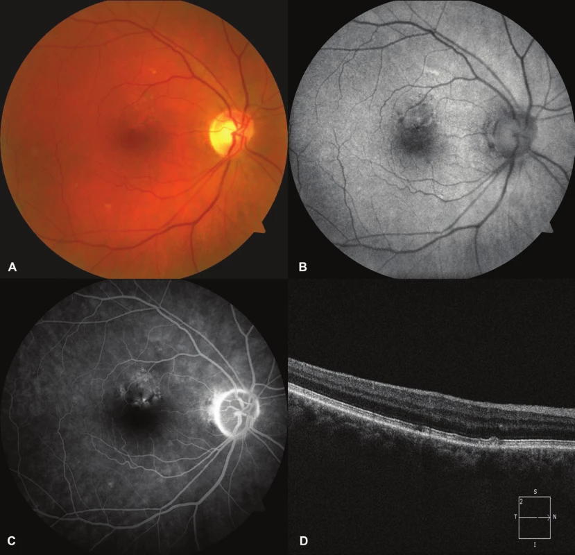 The fundus of the eye of the patient with pachychoroid pigment epitheliopathy. A – changes of the retinal pigment drawing on color photography. B – areas of increased or decreased fundus autofluorescence. C – areas of hyperfluorescence correlated with destruction of RPE on FAG. D – RPE abnormalities on OCT.