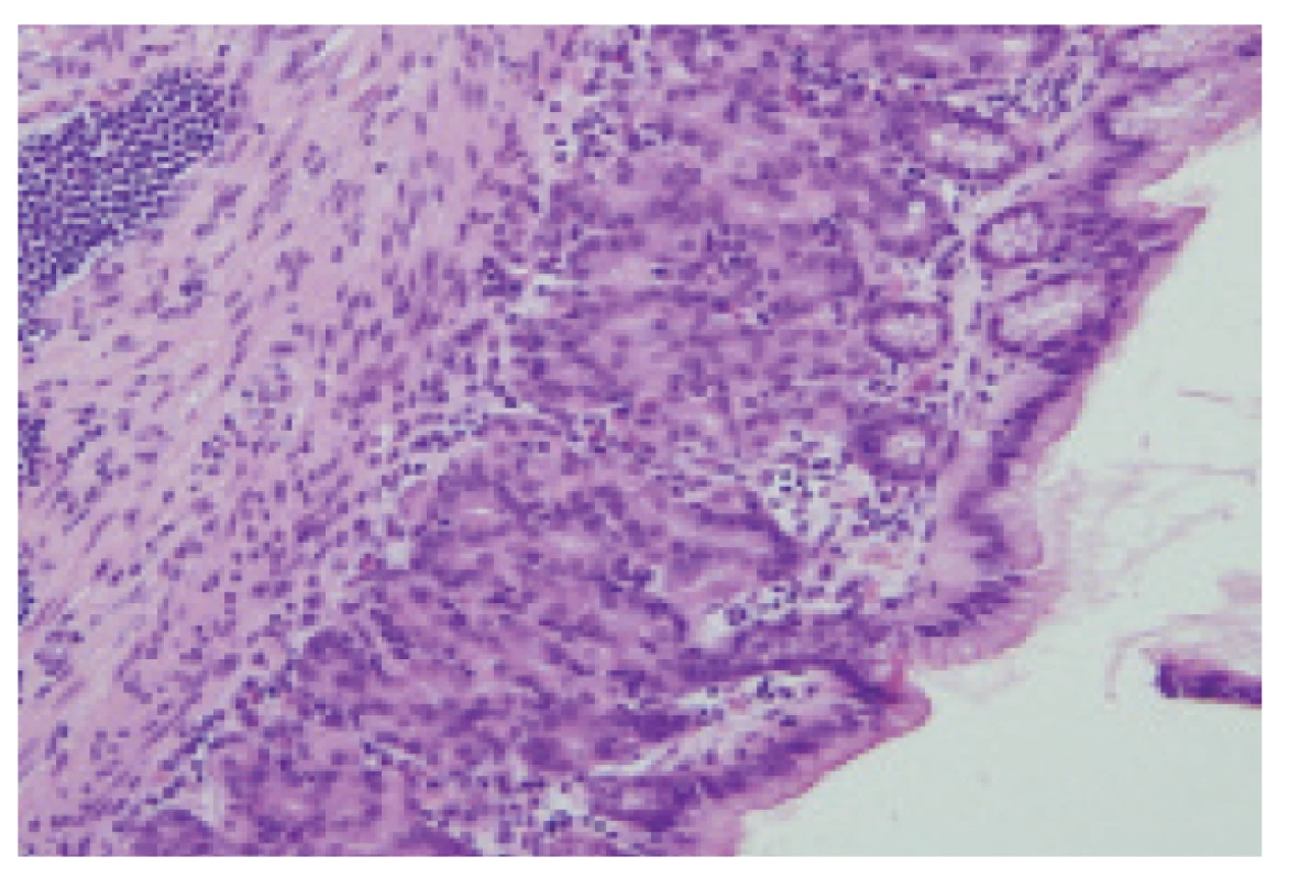 One of the histological samples showing intestinal
mucosa. Haematoxylin and eosin, enlarged 200x