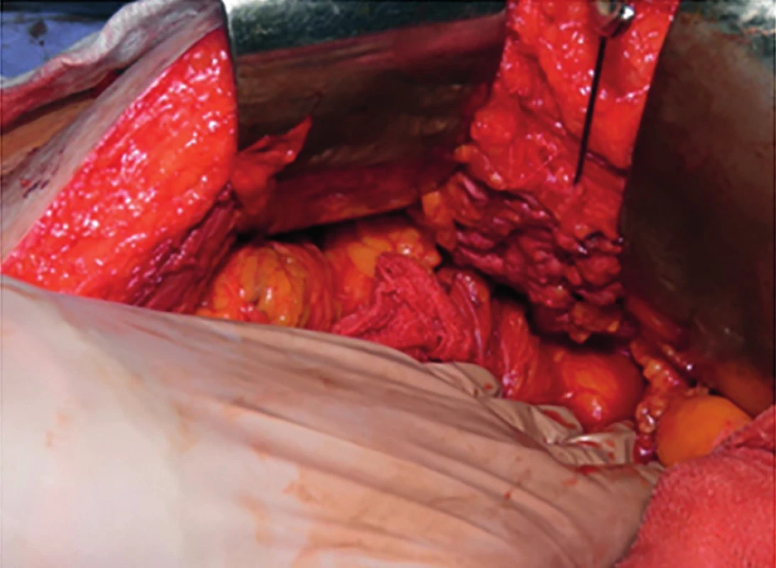 Stav po uzavretí bránky lumbálnej hernie<br>
Fig. 4: Status after closing the lumbar hernia gate