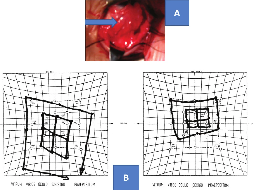 Diagnostic balance sheet in palsies of inferior rectus muscle: hypertrophic pathological tissue by tendon of inferior rectus muscle – arrow (A), finding on Hess screen – right-sided hypertropia and secondary hypotropia on double surface on left.