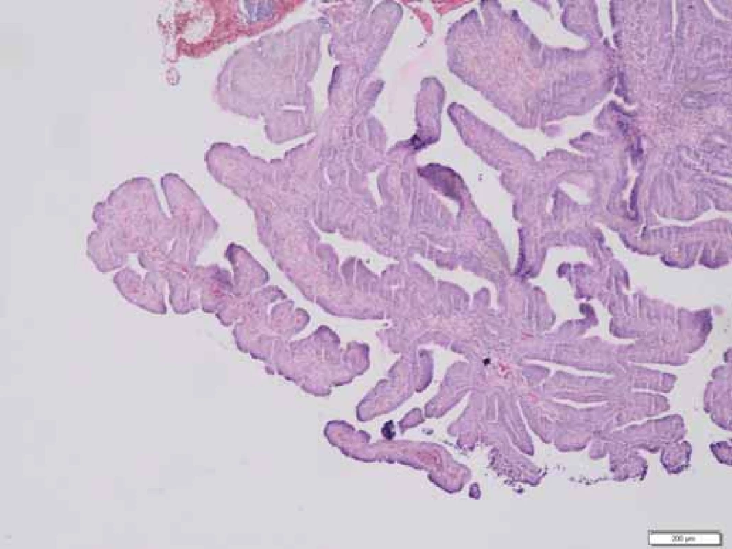 Histologie – polypózní adenomatózní léze. Zvětšeno:
40×.