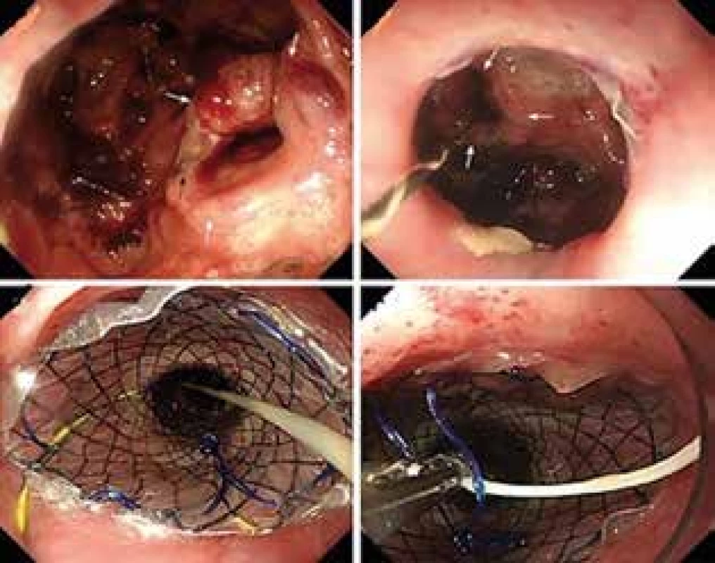 Použitie stentu v prípade dehiscencie anastomózy
(vlastný archív)<br>
Fig. 1: Use of stent in case of anastomosis dehiscence
(custom archive)