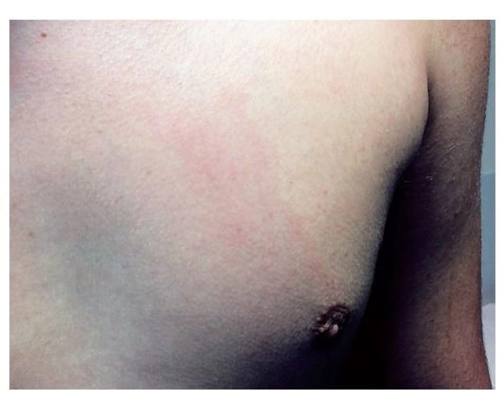 Erythema migrans