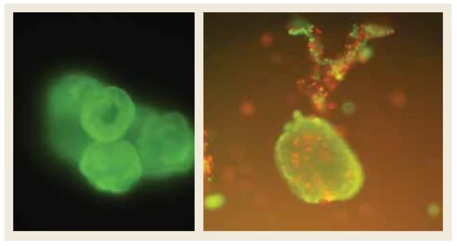 Farbenie na vitalitu. Akridine orange farbí živé bunky na zeleno, propídium jodid
farbí mŕtve bunky do oranžova. Zdroj: IKEM, Praha. <br> 
Fig. 4. Coloring for vitality. Acridine orange stains living cells green, propidium iodide stains
dead cells orange. Source: IKEM, Prague.