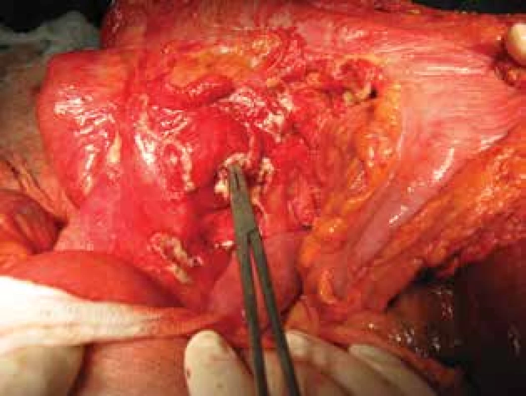 Peroperační nález s fistulací jdoucí z ilea do
mezenteria
Fistulace byla lokalizovaná 10 cm před anastomózou. Do
fistulace zaveden peán.<br>
Fig. 2: Intraoperative findings showing fistula going from
the ileum to mesentery
The fistula was located 10 cm before the anastomosis. A pean
is inserted into the fistula.