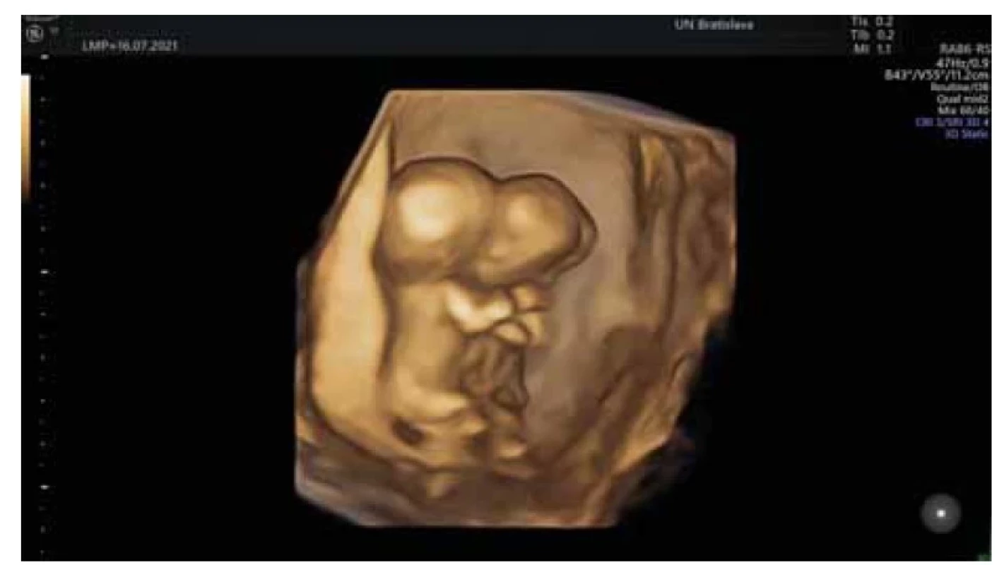 Thoracopagus, graviditas hebdomadis 12+5, 3D surface snímka plodov
in utero pri finálnej diagnostike (archív II. GPK LF UK a UN Bratislava).<br>
Fig. 2. Thoracopagus, graviditas hebdomadis 12+5, 3D surface image of fetuses
in utero during the final diagnosis (archive II. GPK LF UK and UN Bratislava).