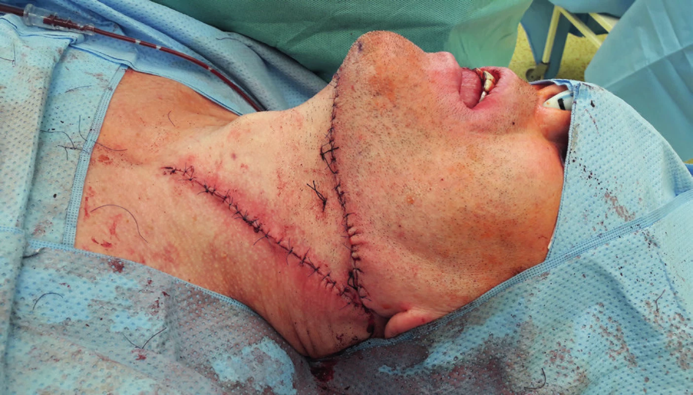 View of the submental flap donor site (author’s archive)