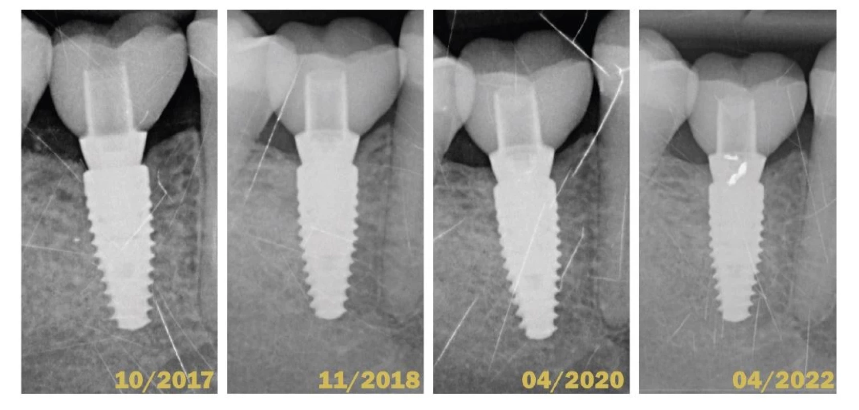 Porovnanie štyroch
intraorálnych röntgenových
snímok v horizonte piatich
rokov.<br>
Fig. 6
Comparison of 4 intraoral
X-rays in 5-years horizon.