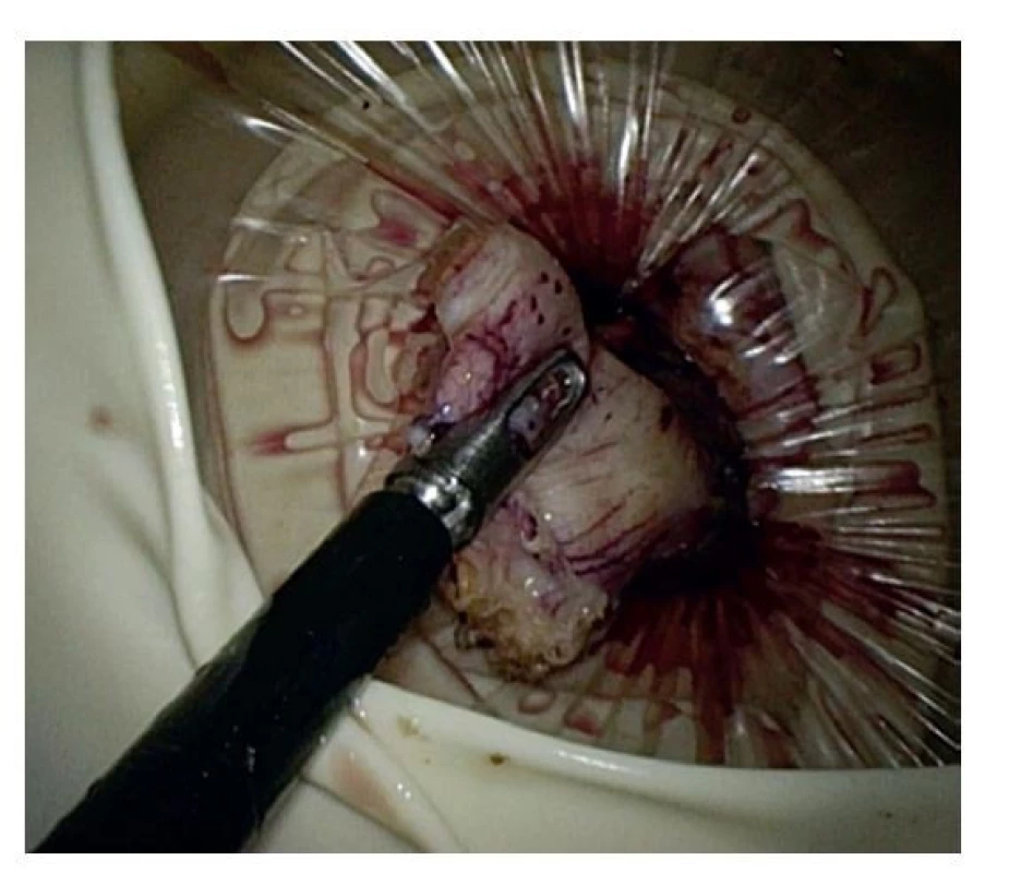 Pohled do portu při extrakci resekovaného apendixu<br>
Fig. 5: View through the port during extraction of the resected
appendix