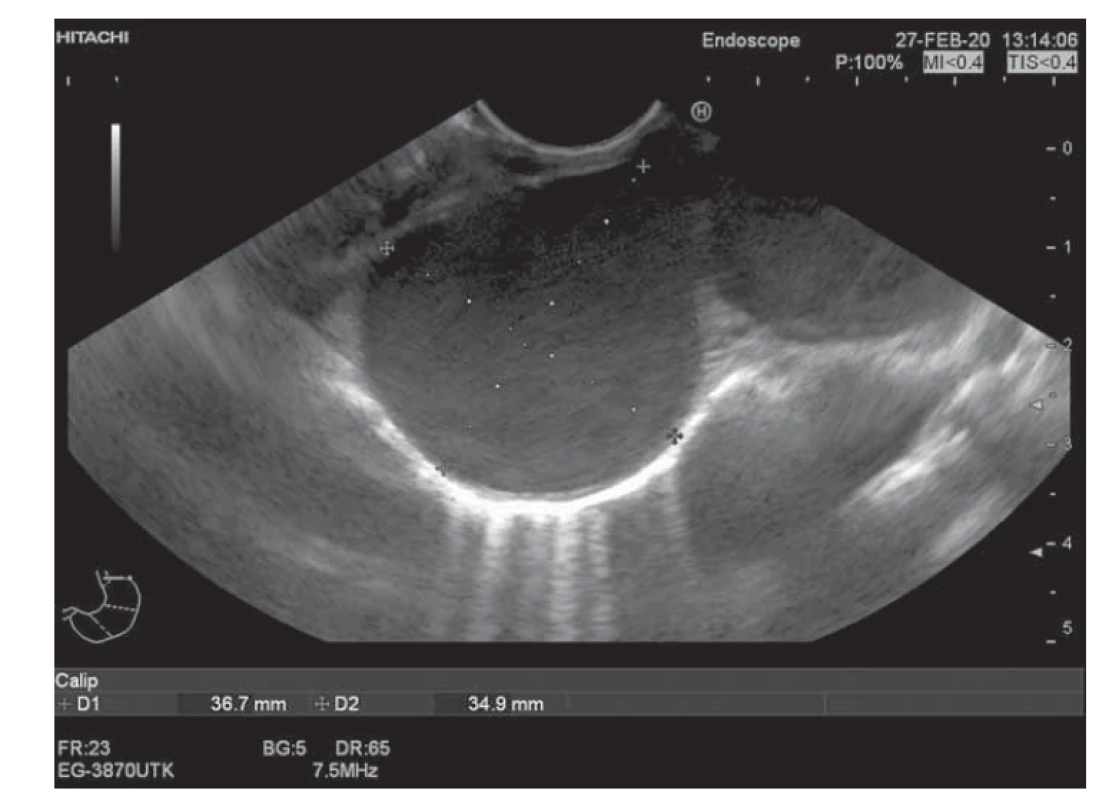 Duplikačná cysta ezofágu: EUS obraz.<br>
Fig. 1. Duplicative esophageal cyst: EUS image.