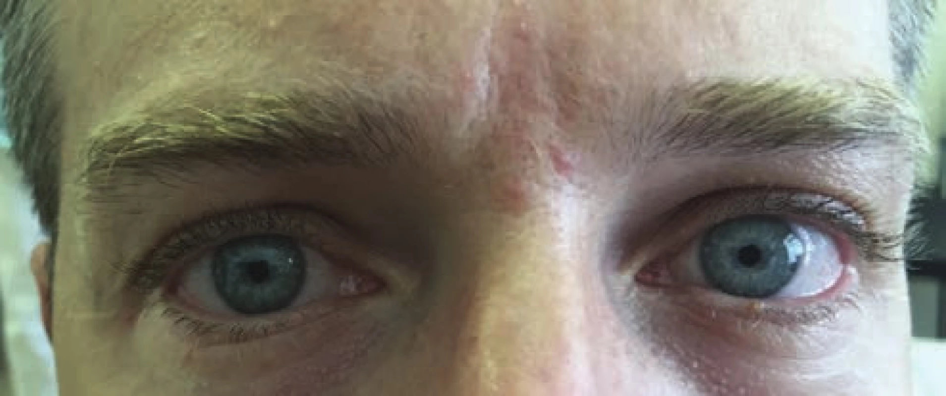 Patient after application of coll. pilocarpine 0.125 % gtt
and subsequent contraction of pupil in right eye