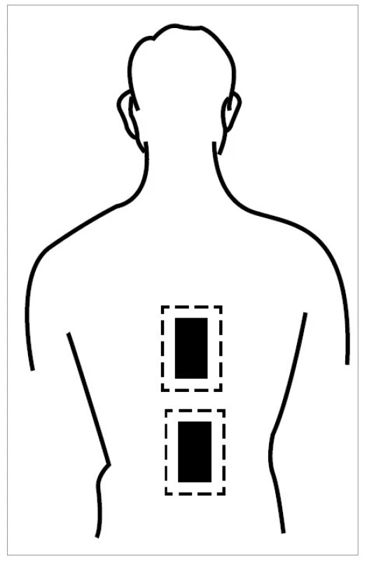 Aplikace Träbertových proudů v lokalizaci EL3<br>
Fig. 1. Application of Träbert currents in EL3 localization
