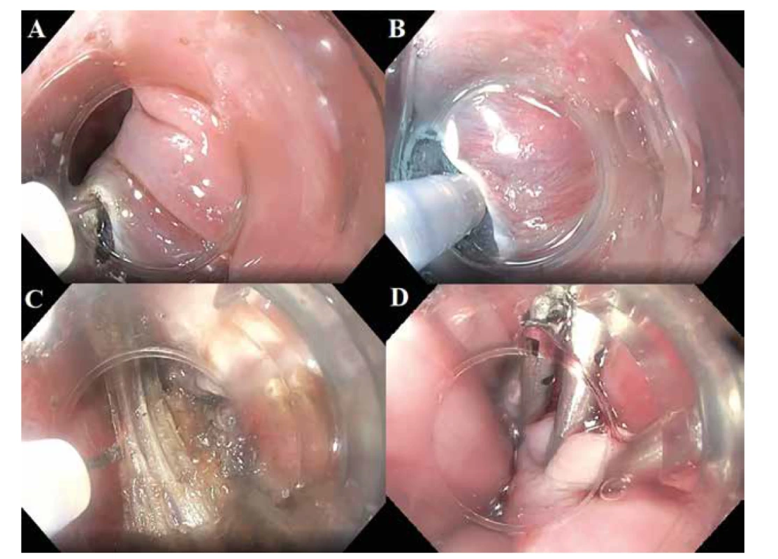 Zenkerův divertikl – Z-POEM<br>
A) slizniční incize B) submukózní tunelizace C) myotomie, D) uzávěr sliznice klipy<br>
Fig. 3: Zenker´s diverticulum – Z-POEM<br>
A) mucosal incision, B) submucosal tunneling, C) myotomy, D) mucosal closure with clips