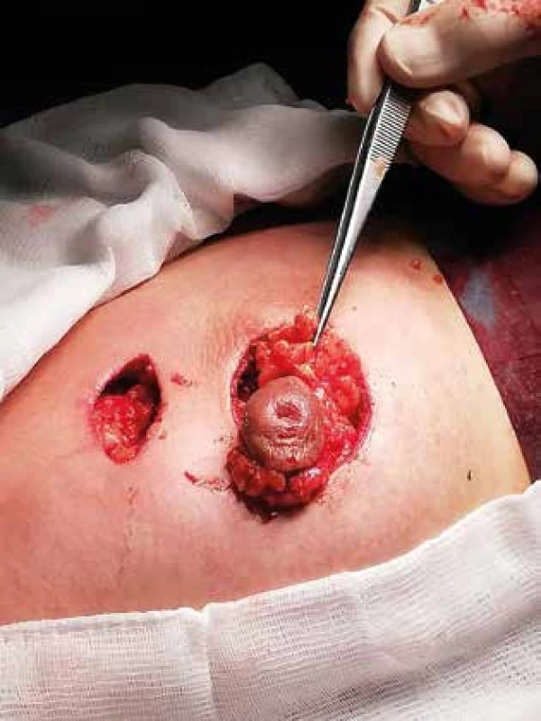 Peroperační rozsah resekce zánětem postižené
tkáně <br>
Fig. 2: Intraoperative extent of resection of the affected
tissue