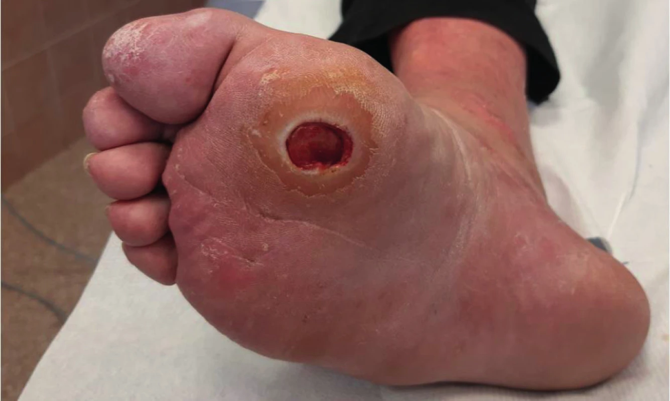 Neuropatický defekt nohy u pacienta s diabetem