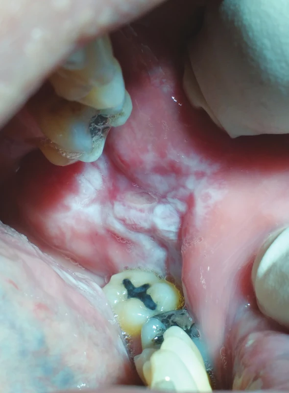 hypersenzitivita na kovové
stomatologické materiály
(z archivu autorky)<br>
Fig. 5
Lichenoid stomatitis,
immune reaction to dental
metal materials
(author´s archive)