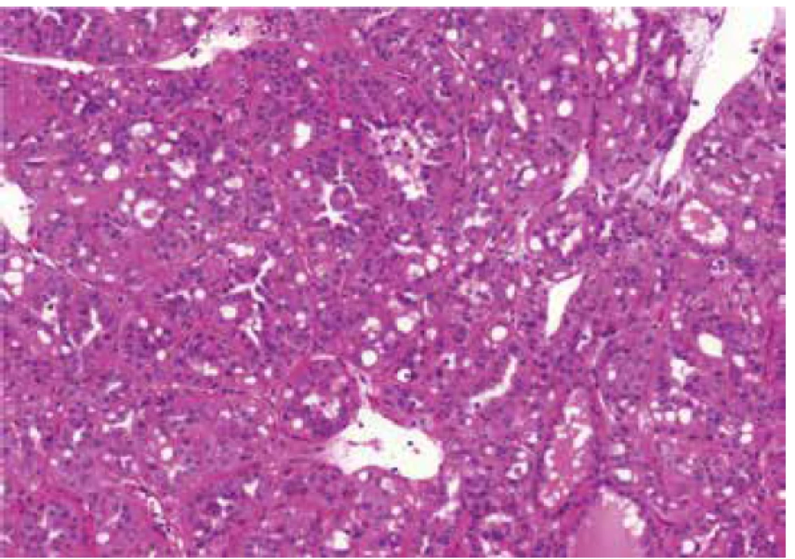 Cribriform pattern in case of renal cell carcinoma mimicking FHRCC
(FH-like RCC). HE 100x