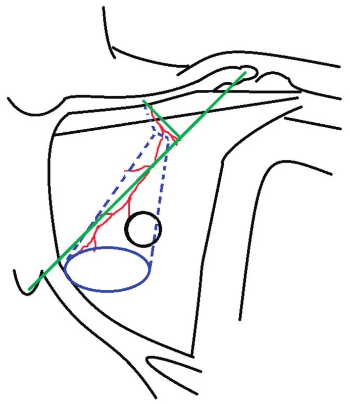 Preoperative planning: green color - the line from the
shoulder tip to xiphoid and its perpendicular from middle of
the clavicle showing expected position of pectoral branches of
thoracoacromial artery; blue color – skin island design; dashed
blue line – muscle dissection design