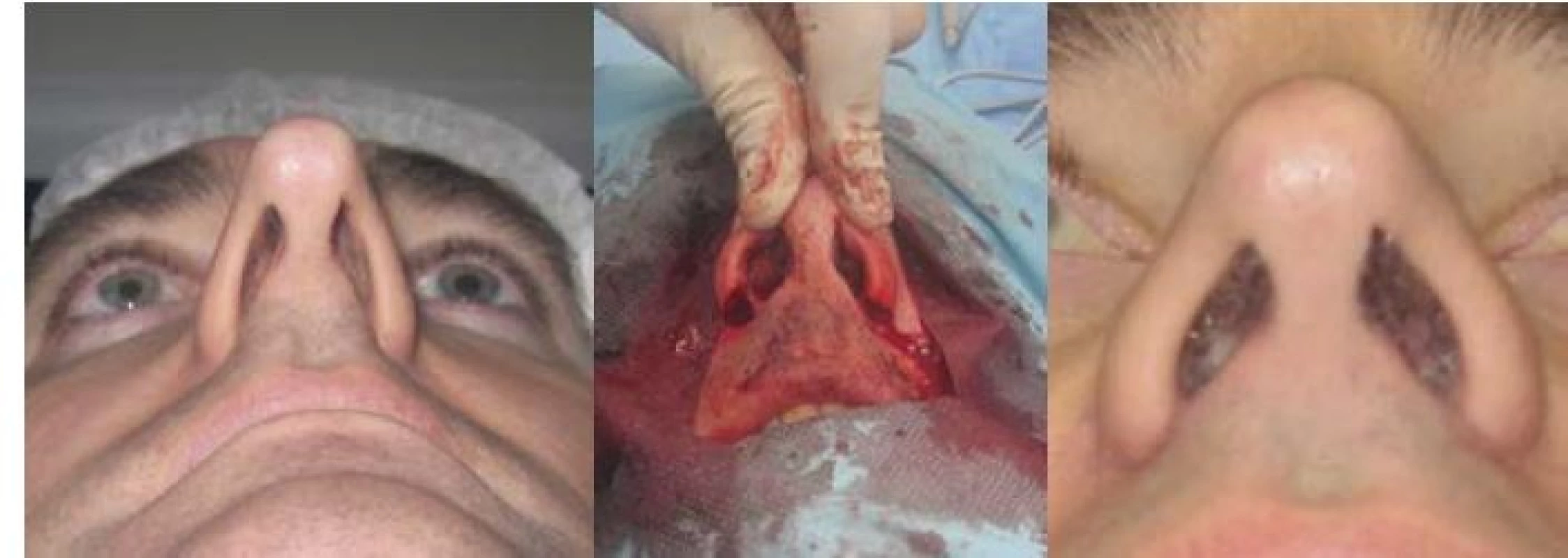Zmenšení nozder:<br>
a) před operací<br>
b) klínovitá excize nosních křídel<br>
c) po operaci