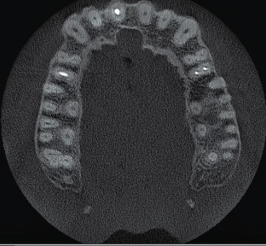 Horizontální řez
CBCT snímku ve střední
třetině délky kořenů horních
středních řezáků. Je
viditelné rozšíření nazopalatinálního
kanálu a taktéž
pět menších aberantních
kanálků, které dále vyúsťují
jako foramina Scarpae