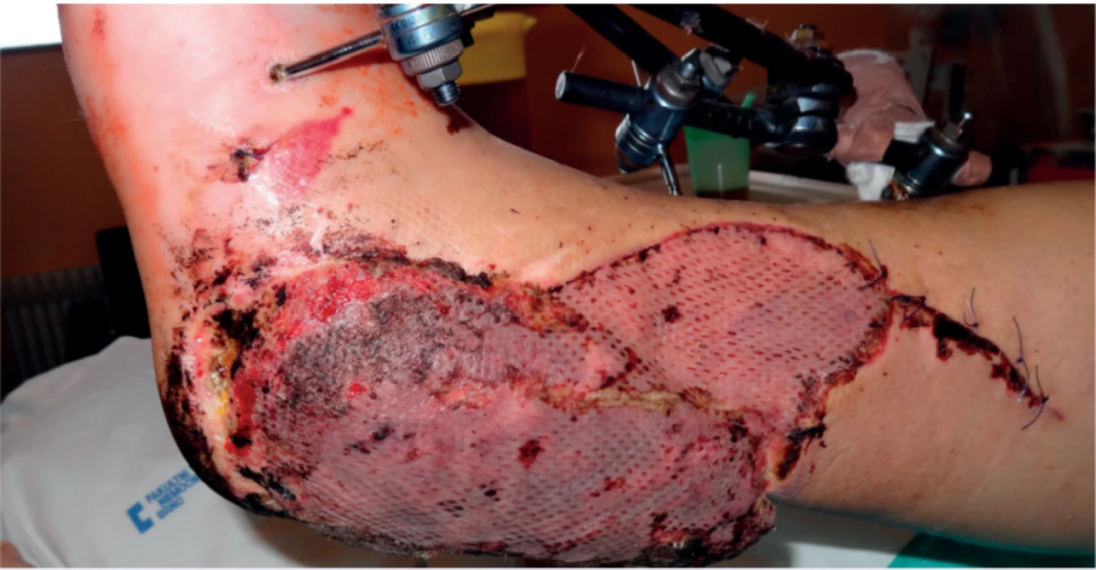 5th day after free flap reconstruction, newly created defect in heal region