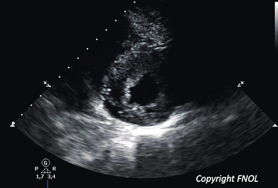Echokardiografický obraz u 13leté pacientky s koncentrickou formou HKMP (parasternální krátký řez levou komorou).<br>
Fig. 3. Echocardiographic 2D scan showing an concentric form of hypertrophic cardiomyopathy in a 13yr old girl; parasternal short view.