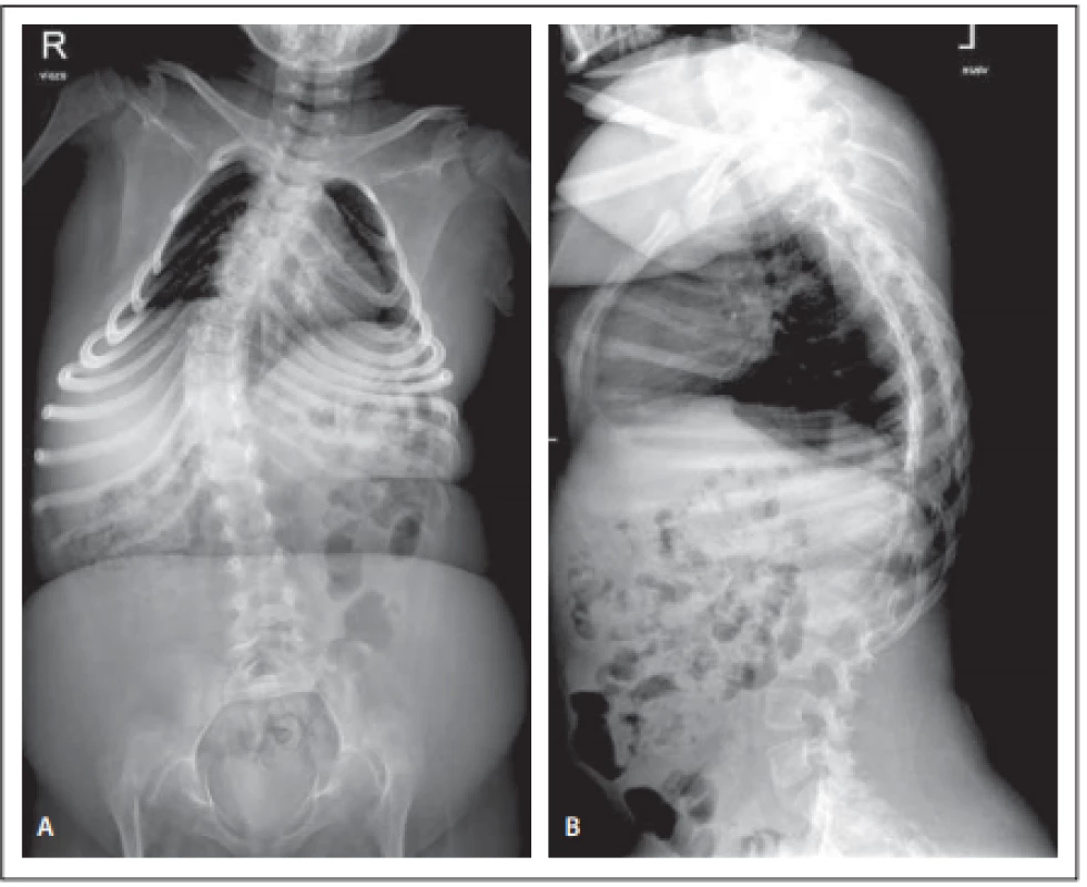 Předoperační předozadní (A) a bočný (B) snímek páteře, pravostranná skolióza
s vrcholem T9, 45° dle Cobba.<br>
Fig. 1. Předoperační předozadní (A) a bočný (B) snímek páteře, pravostranná skolióza
s vrcholem T9, 45° dle Cobba.