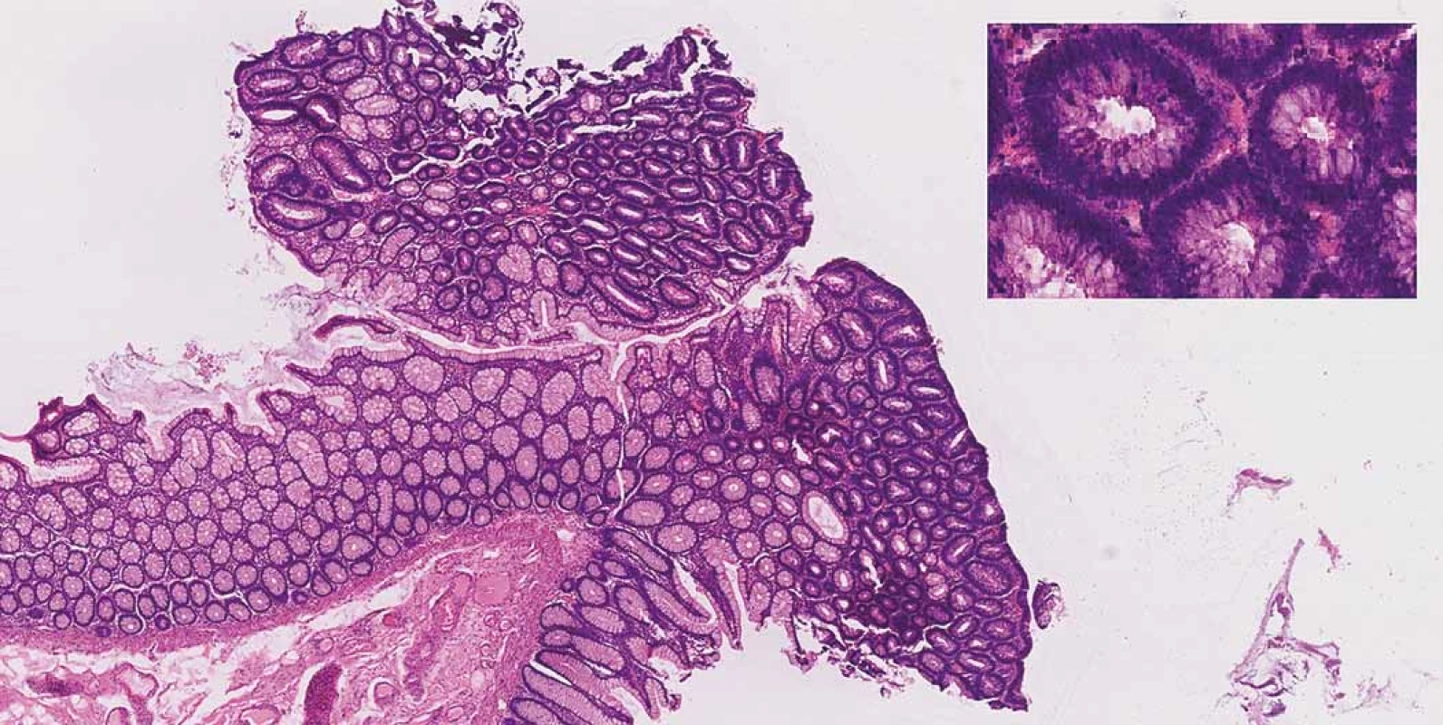 Tubular adenoma with low-grade dysplasia, haematoxylin and eosin staining 20×. Inset right corner: features of
dysplasia (enlarged, hyperchromatic, basally located nuclei, loss of mucin), haematoxylin and eosin staining 400×.<br>
Obr. 2. Tubulární adenom s nízkým stupněm dysplazie, barvení hematoxylin-eozinem 20×. Vpravo nahoře: znaky dysplazie
(zvětšená, hyperchromatická, bazálně umístěná jádra, ztráta mucinu), barvení hematoxylineozinem 400×.