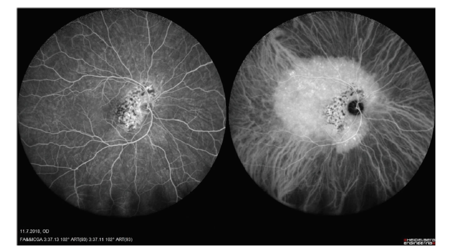 Širokoúhlý snímek fluorescenční angiografie a angiografie s indocyaninovou zelení hemangiomu
cévnatky