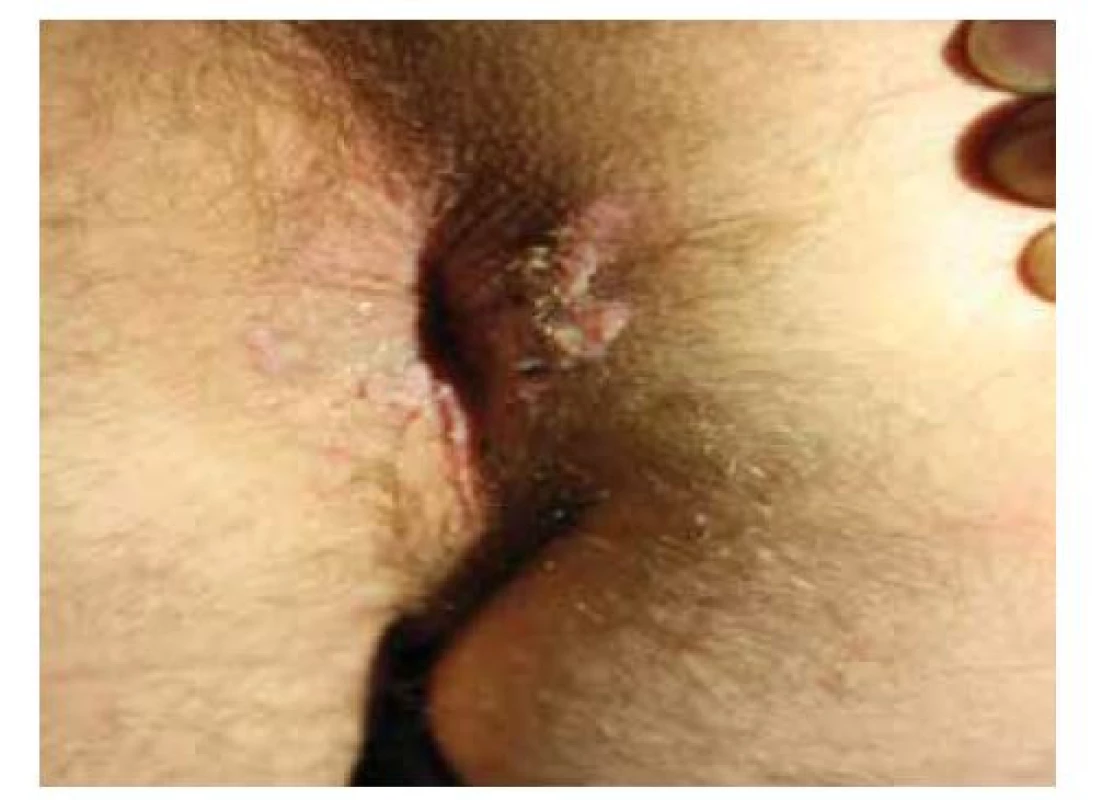 Perianální condylomata acuminata<br>
(archiv Dermatovenerologické kliniky 2. LF UK a FN Bulovka)