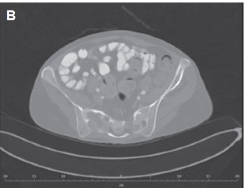 Stagingové diagnostické CT se stacionárním ložiskem osteolýzy
v massa lateralis sakrální kosti vpravo. Nález byl porovnán
s předchozími CT vyšetřeními, které byly provedeny pro kontrolu
stavu hojení fraktury stydké kosti. A – frontální řez. B – transaxiální
řez.
