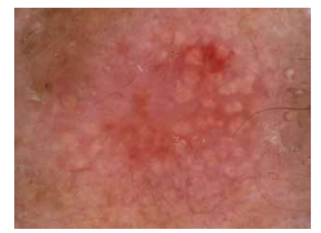 Dermatoskopie aktinické keratózy