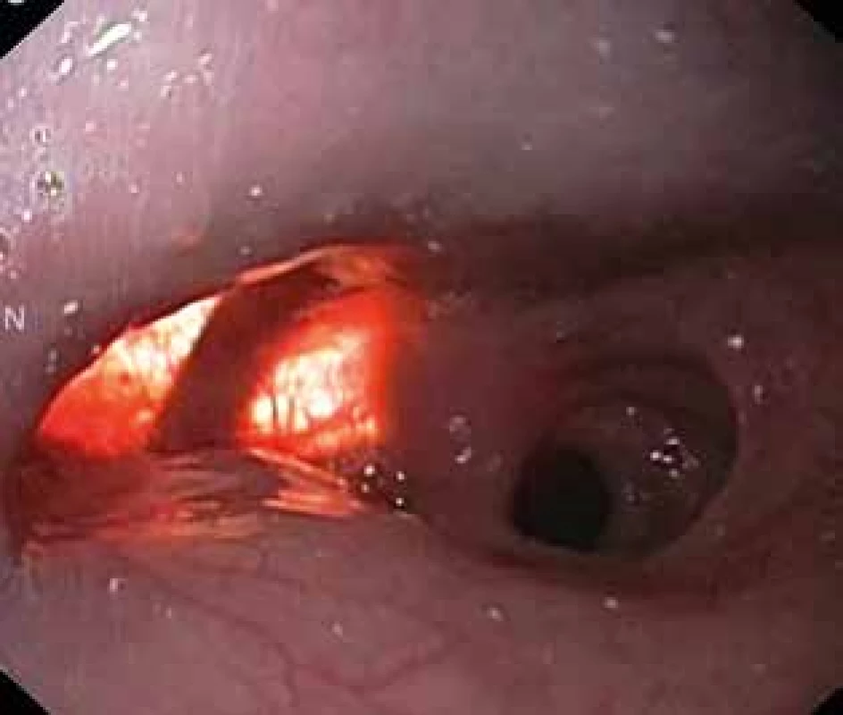 Intraoperační endoskopie při preparaci divertiklu jícnu <br>Fig. 6: Intraoperative endoscopy in the preparation of oeso phageal diverticulum
