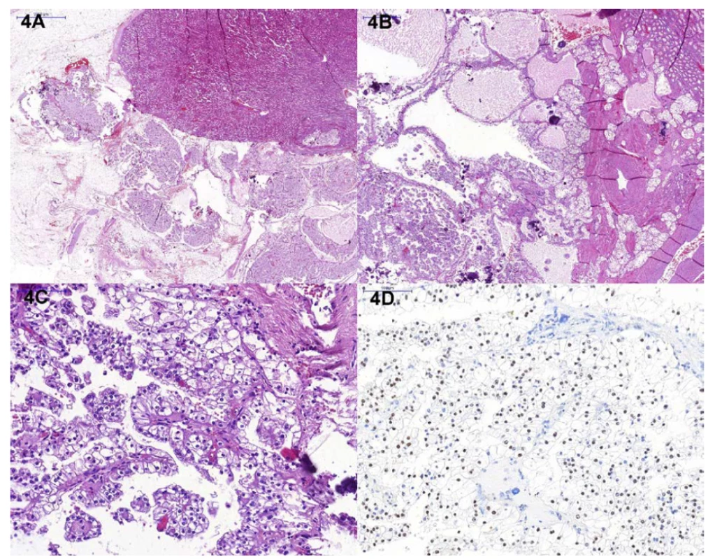 Histologický nález; A – přehledové zvětšení, B – detail cystického uspořádání tumoru, fokálně se solidnější
mi okrsky, přítomny jsou výrazné kalcifikace, C – papilární struktury, lemovány buňkami se světlou cytoplazmou,
D – imunohistochemický průkaz TFE3<br>
Fig. 4. Histological finding; A – overview, B – detail, cystic appearance of the tumor, focally with initially solid
areas and calcifications, C – typical papillary structures, lined by cells with clear cytoplasm, D – TFE3 immunohistochemistry
(nuclear positivity)