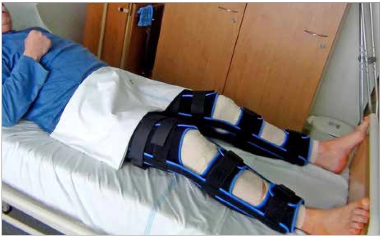 Pooperační imobilizace kolen<br>
Fig. 3. Postoperative knee immobilization