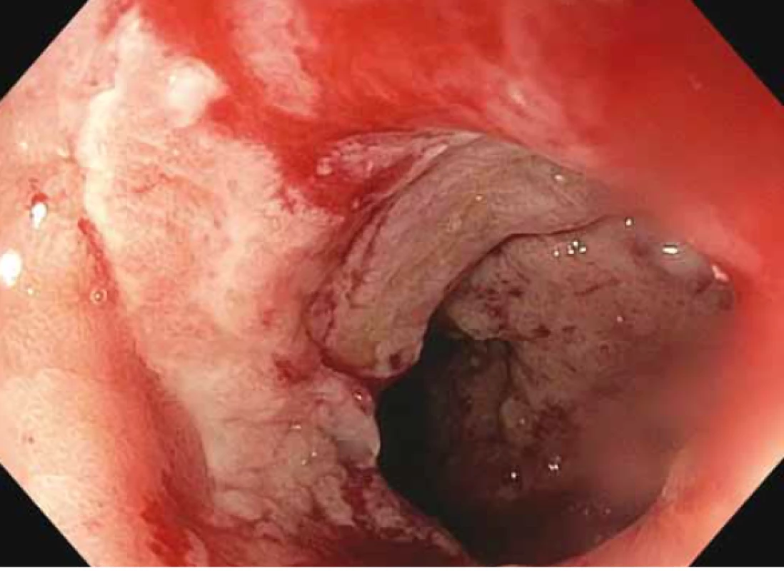 Horní endoskopie – pohled do vygranulované
dutiny bez dalších nekrotických hmot těsně po extrakci
metalického stentu.<br>
Fig. 6. Upper endoscopy – view of the pelleted cavity
without additional necrotic masses just after the metallic
stent extraction.
