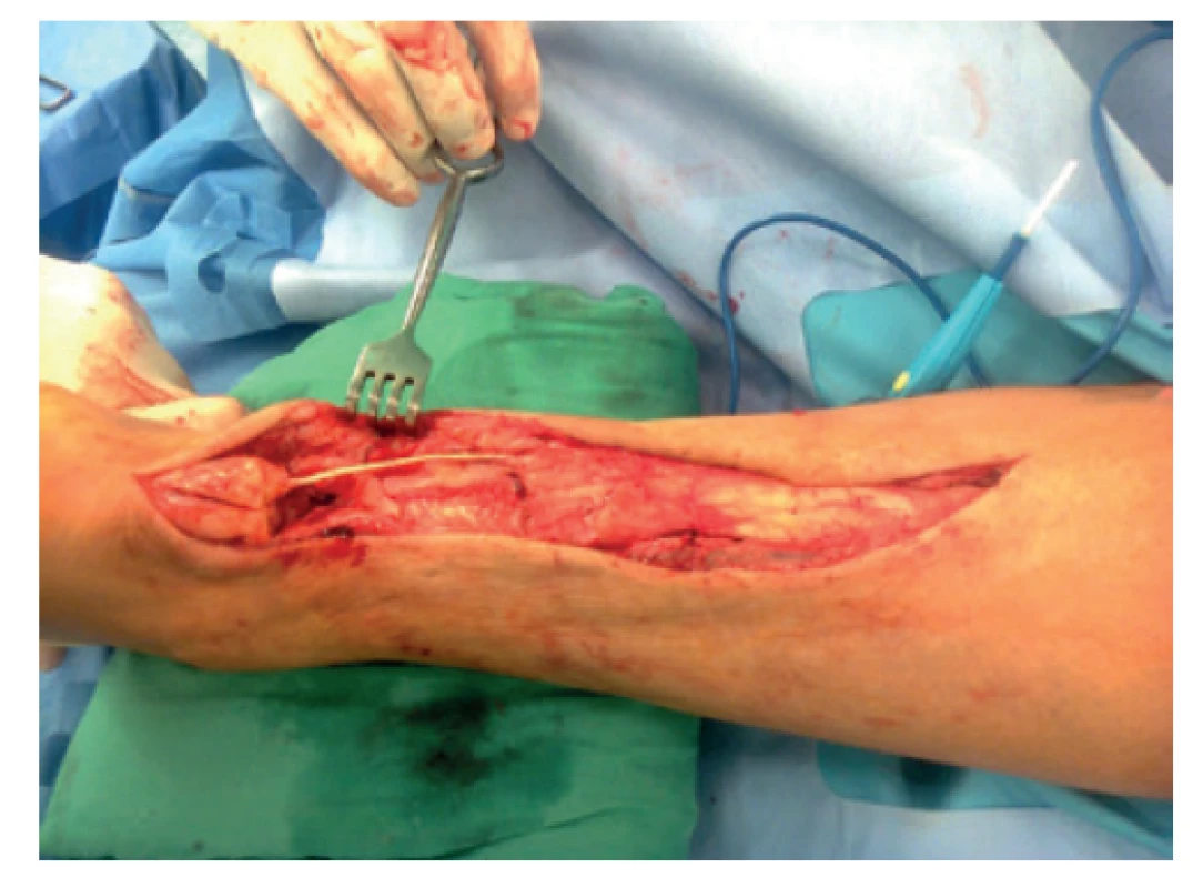 Paramediální esovitý operační přístup se zjištěním
velikosti defektu ve šlaše cca 10 cm<br>
Fig. 6: Paramedial S-shaped surgical approach revealing
a tendon defect of approximately 10 cm