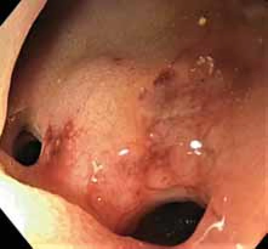 Bihepatikojejunoanastomóza
po balonové dilataci cestou
endoskopicky vytvořené
duodenojejunoanastomózy.<br>
Bihepaticojejunoanastomosis
after balloon dilatation by endoscopically
formed duodenojejunoanastomosis.