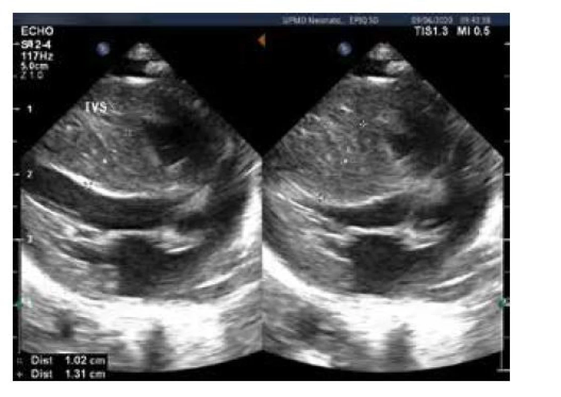 Echokardiografie, B obraz, hypertrofie myokardu,
měření šíře komorového septa v systole a diastole. Pacient
akceptorem při transfuzním syndromu dvojčat, komplikovaném
akutní fetofetální transfuzí po úmrtí dvojčete. Těžká anemie
korigována transfuzí in utero